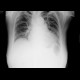 Idiopathic lung fibrosis: X-ray - Plain radiograph